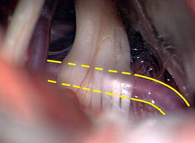 Krónikus csillapíthatatlan fájdalom - arcidegzsába műtéti kezelése. Műtéti mikroszkópon keresztül látható az V. agyideg, nervus trigeminus , mely ki van feszítve egy előtte kersztbe haladó érkacs által