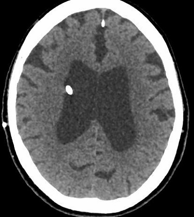 Vízfejűség - hydrocephalus miatt agykamrába behelyezett shuntvezeték a CT felvételen