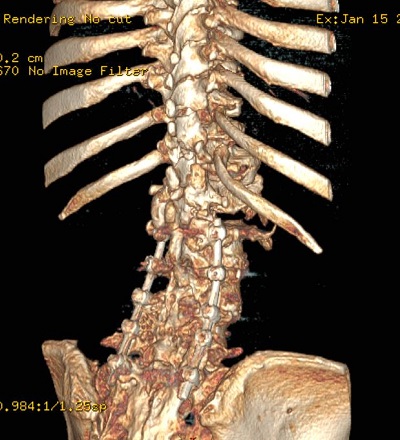 Gerinc fixációs műtét után 3D CT rekonstrukció az ágyéki szakaszon