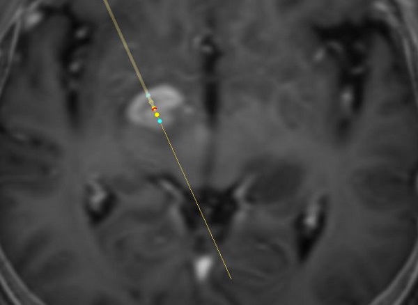 A középagyban elhelyezkedő agydaganat sztereotaxiás biopszia terve Vister-3D programmal