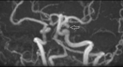 Agyi aneurizma MR-angiográfiás képe