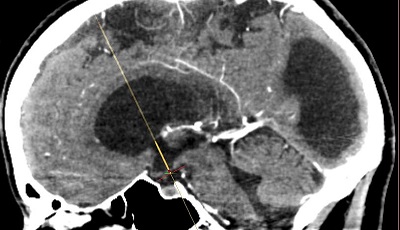 Vízfejűség miatt - végzett endoszkópos III. agykamra fenesztráció -venticulosisternostomia CT alapú terve Vister-3D számítógépes tervzőprogrammal