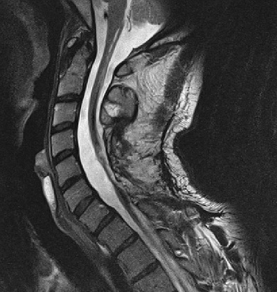 A C-VI magasságban a gerincvelőben elhelyezkedő ependymoma eltávolítása után a syringomyelia megszűnt