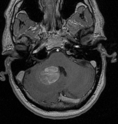 Kisagyban hemangioma miatt hirtelen kialakult agyvérzés látható a műtét előtt készült MR felvételen