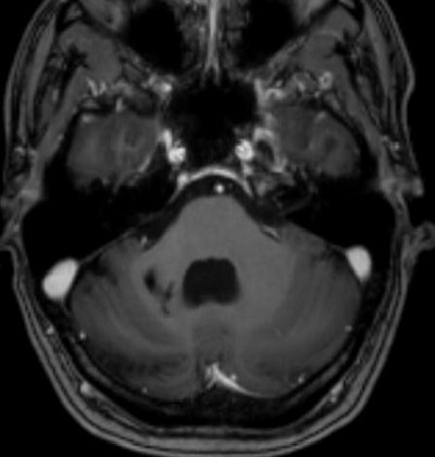 Kisagyi agyvérzés után eltávolított vérömleny és hemangioma műtét után készült MR felvétel