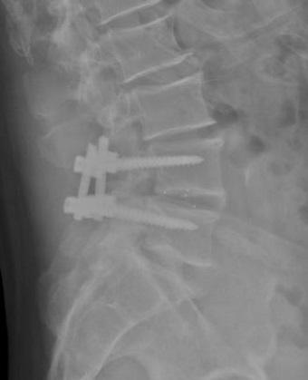 Csavaros rudas gerinc rögzítés a IV-es és V-ös ágyéki csigolya között cage beültetéssel- Röntgen felvétel oldalról