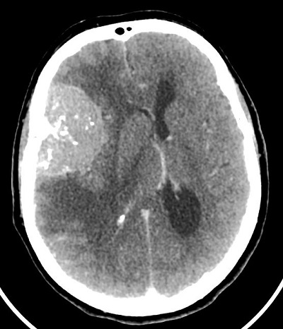 meningeoma a Sylvius ároknak megfelelően - CT felvétel