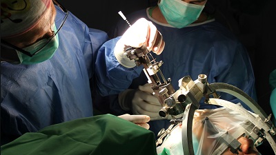 DBS műtét agyi elektróda beültetése