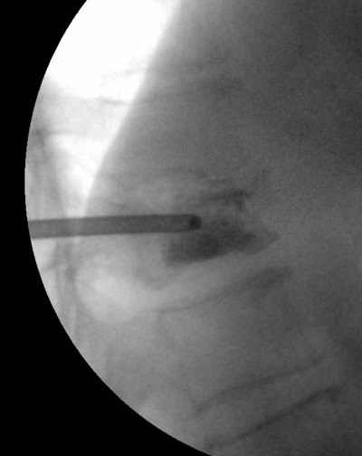 Intraopertív Röntgen-felvétel csigolyatörés - összeroppant csigolya feltöltése közben