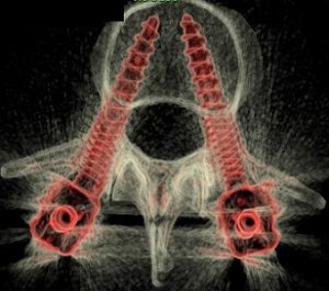 Csontablakos CT felvétel a kétoldalról csigolyatestve helyezett csavarok piros kontúrral
