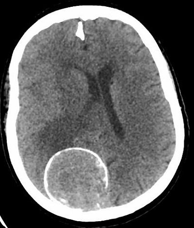 Koponya CT vizsgálaton elmeszesedett meningeoma látható