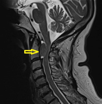 C2 csigolya mögött, a gerincvelőt összenyomó gerincburok daganat -meningeoma MR képe