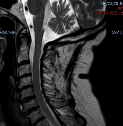 Műtét utáni MR kép. A gerincvelő összenyomása megszűnt a daganatot teljesen eltávolítottuk.