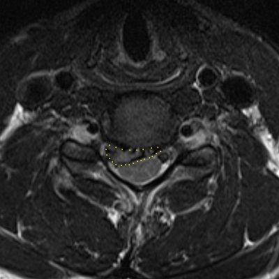 CIV-V csigolyák közötti nyaki porckorongsérv axiális síkú MR felvétele